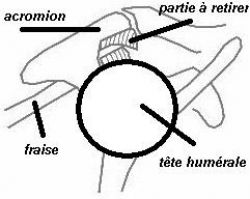 Acromioplastie