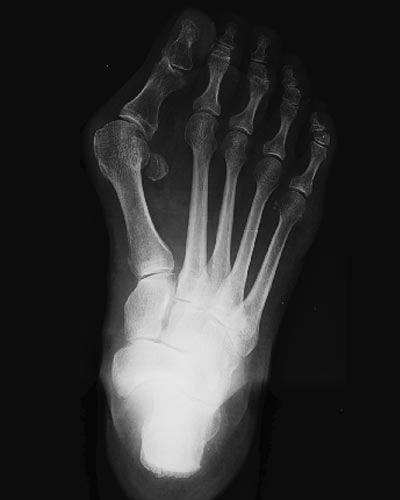 Avant pied de face avec Hallux Valgus