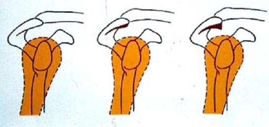 Bec acromial