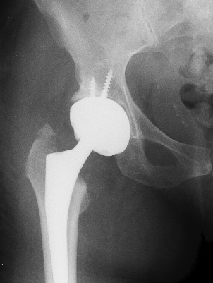 Coxarthrose après l'implantation d'une prothèse totale de la hanche