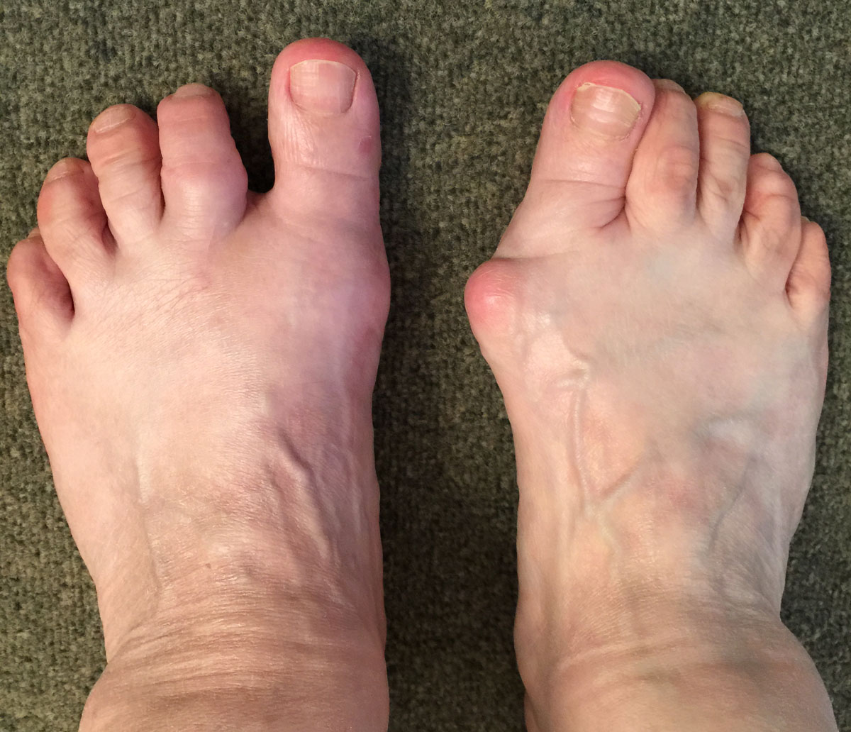 Hallux Valgus opéré sur le pied gauche et pied droit avant l'intervention.