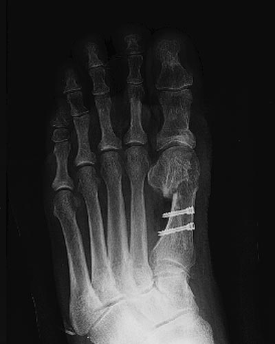 Hallux valgus pied gauche après intervention