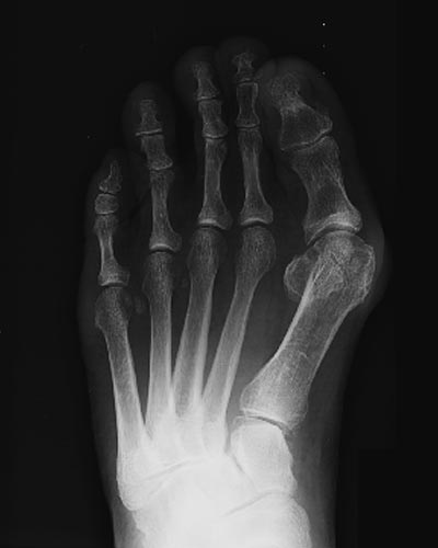 Hallux valgus pied gauche avant intervention