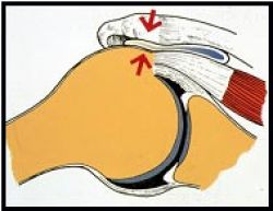 La maladie des tendons de l'épaule