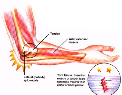 La tendinite du coude