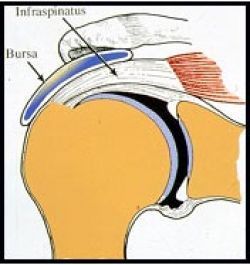 Maladie des tendons de l'épaule