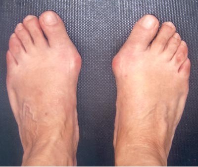 Photo d'un Hallux Valgus modéré non opéré