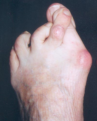 Photo d'un Hallux Valgus sévère non opéré