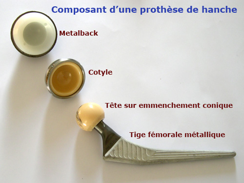 Photo de prothèse de hanche