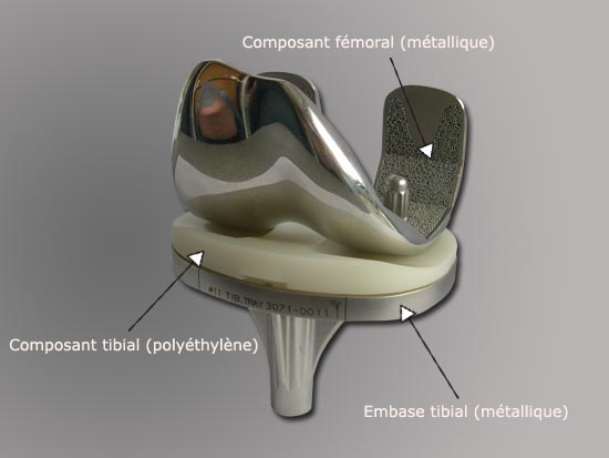 Photo : Implant pour une arthroplastie tricompartimentale (prothèse totale)