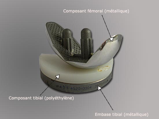 Photo : implant pour une arthroplastie unicondylienne (PUC interne ou latérale)