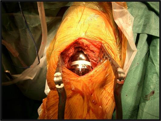 Pose d'une prothèse d'épaule au bloc opératoire