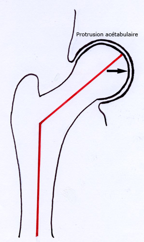 Protrusion acétabulaire