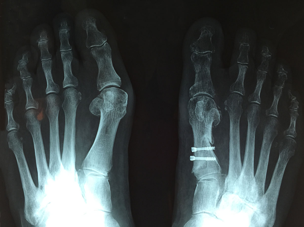 Radio après l'opération de l'Hallux Valgus corrigé sur le pied droit