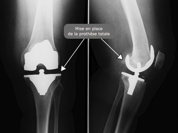 Radio : arthroplastie tricompartimentale (prothèse totale)