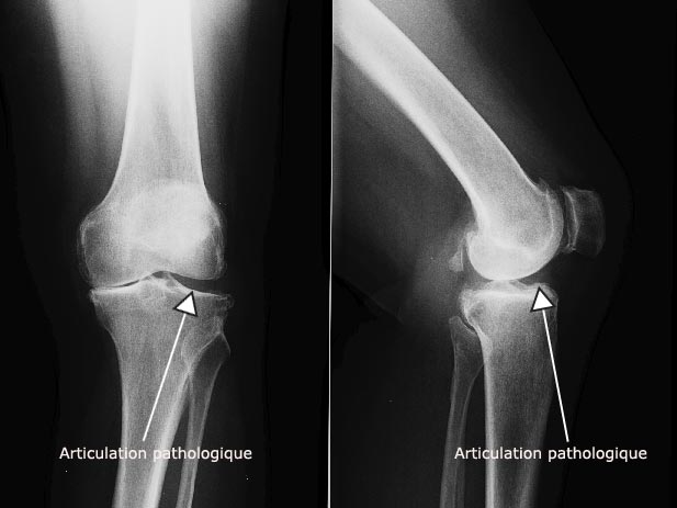 Radio : articulation pathologique