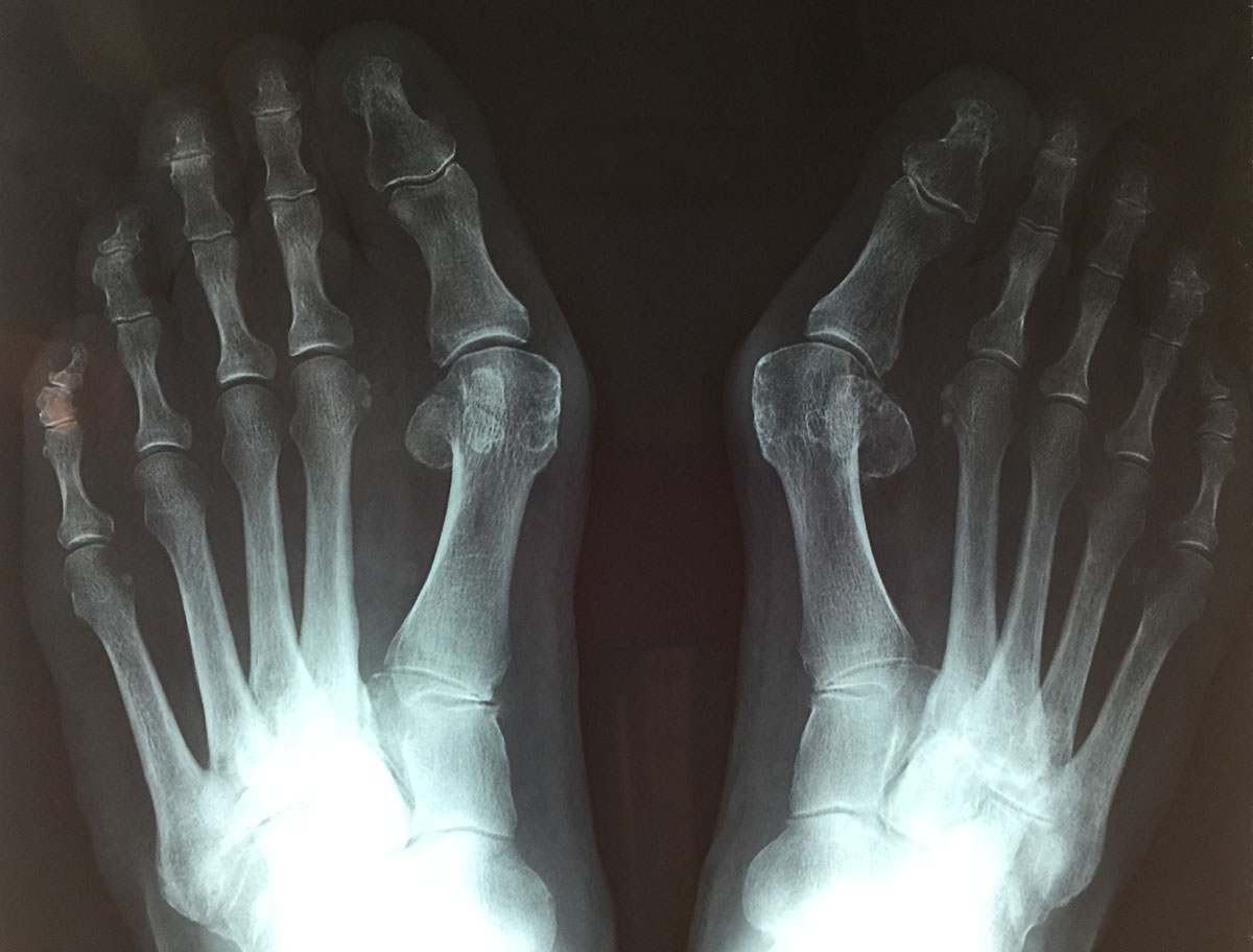 Radio d'un Hallux Valgux sur les deux pieds avant intervention.