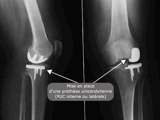 Radio : mise en place d'une prothèse unicondylienne