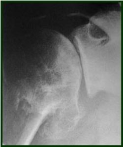 Radiographie arthrose épaule