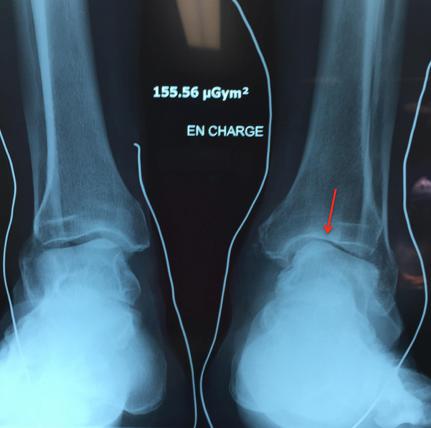 radiographie arthrosique