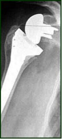 Radiographie avec prothèse d'épaule en place