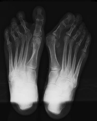 Radiographie gauche 1 an post opératoire, droit pré-opératoire