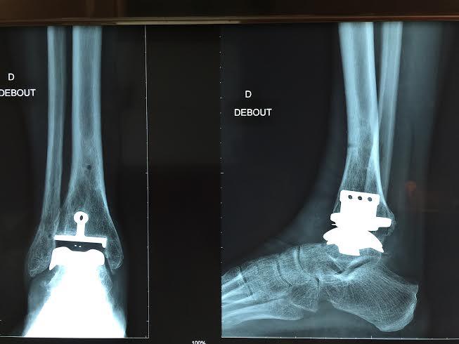 Radiographie implant cheville arthroplastie