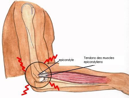 Signes clinique de la tendinite du coude