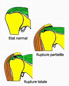 Tendons de l'épaule avec ou sans rupture