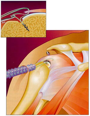 Traitement chirurgical de la rupture des tendons de l'épaule