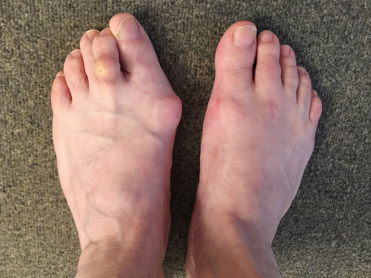 Très beau cas de Hallux Valgus droit opéré et gauche à opérer.