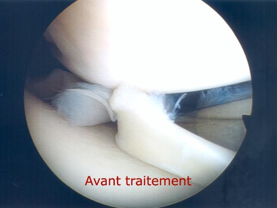 Vue endoscopique : avant traitement