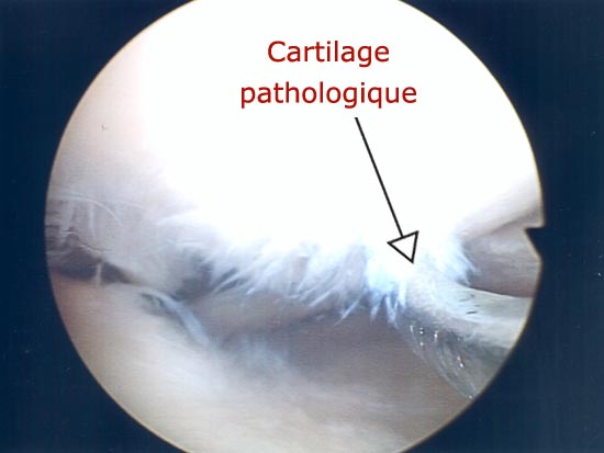 Vue endoscopique : cartilage pathologique