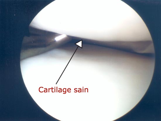 Vue endoscopique : cartilage sain