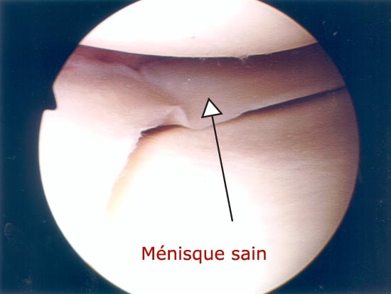 Vue endoscopique d'un ménisque sain