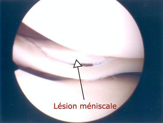 Vue endoscopique d'une lésion méniscale