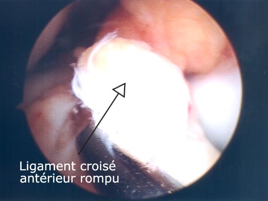 Vue endoscopique : Lésions du ligament croisé antérieur