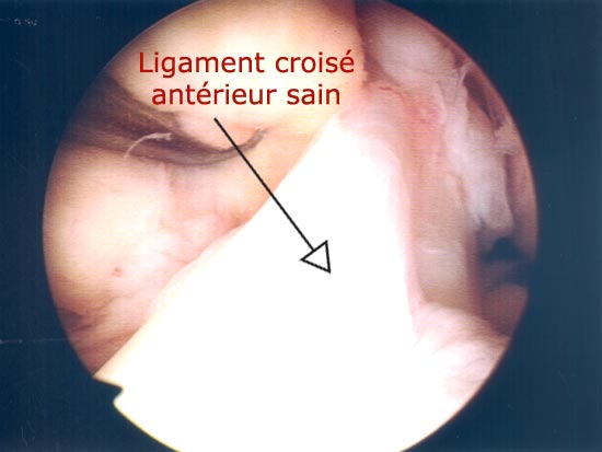 Vue endoscopique : ligament croisé antérieur sain