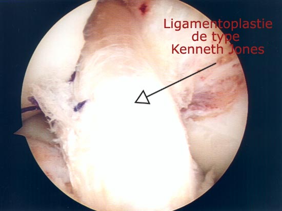 Vue endoscopique : Ligamentoplastie de type Kenneth Jones