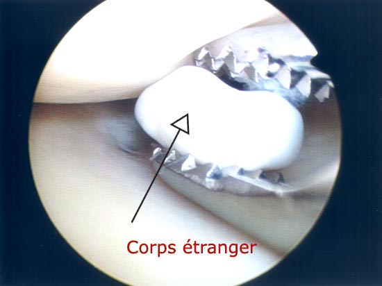 Vue : lésions endoscopiques de corps étrangers